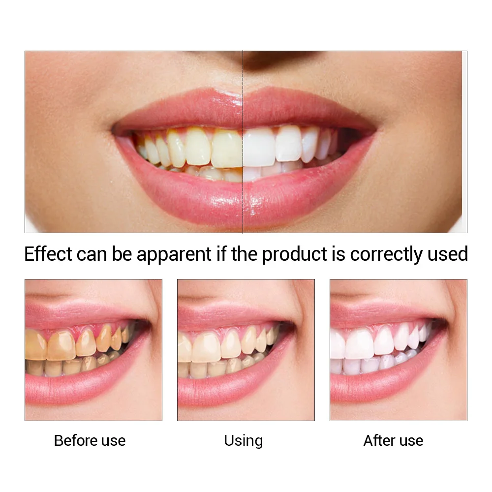 FTEENPLY ฟันไวท์เทนนิ่ง Oral ส - Teeth Whitening Levels บทวิจารณ์และราคา